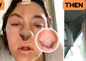 A Woman Got Attacked by a Dog — Now Hair Grows on Her Nose