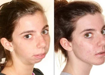 People Who Took the Plastic-Surgery Leap—and Can’t Stop Smiling at the Mirror
