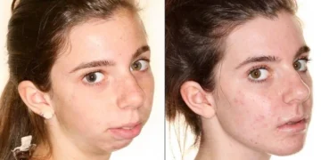 People Who Took the Plastic-Surgery Leap—and Can’t Stop Smiling at the Mirror