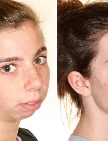 People Who Took the Plastic-Surgery Leap—and Can’t Stop Smiling at the Mirror