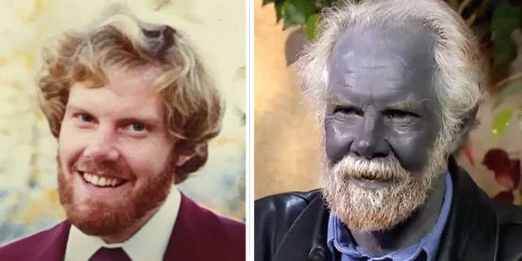 The Heartbreaking Story of a Man Who Became Permanently Blue