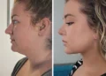 Plastic Surgery Transformations: 10 Stunning Before & Afters