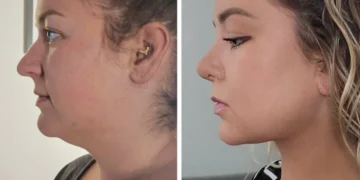 Plastic Surgery Transformations: 10 Stunning Before & Afters