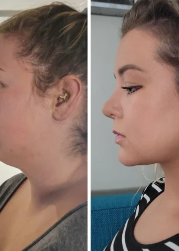 Plastic Surgery Transformations: 10 Stunning Before & Afters